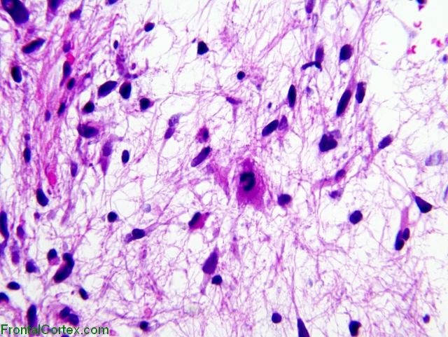 IIIrd ventricular glioma x400